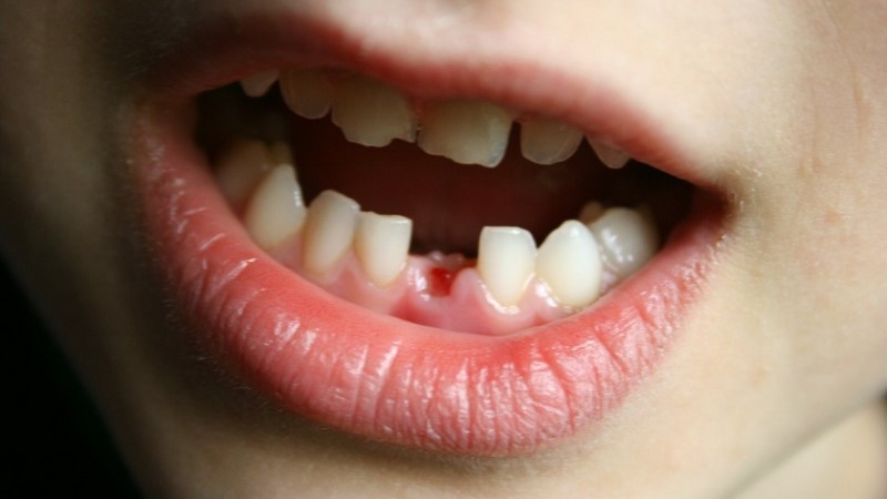 Nằm mơ thấy rụng răng do nhiều nguyên nhân khác nhau